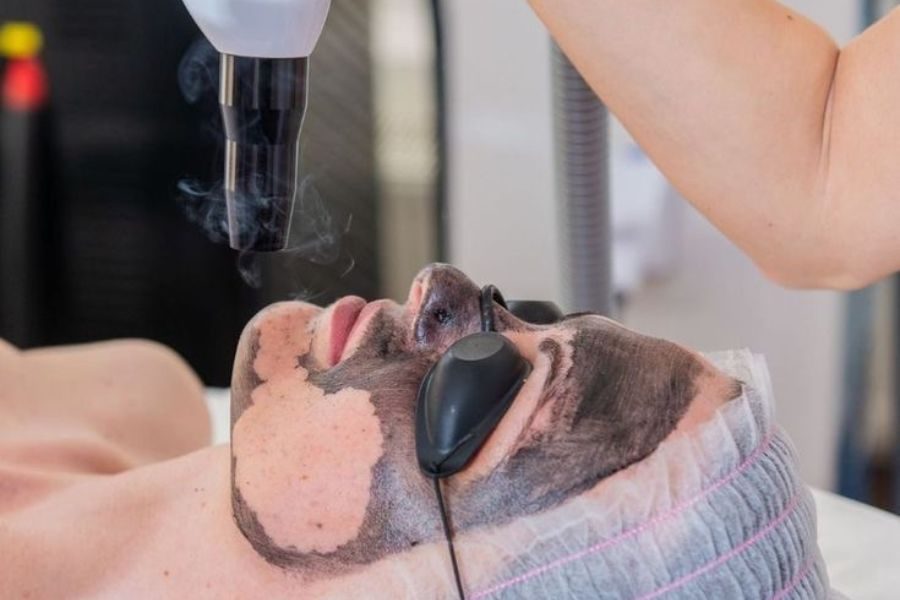 Carbon Laser