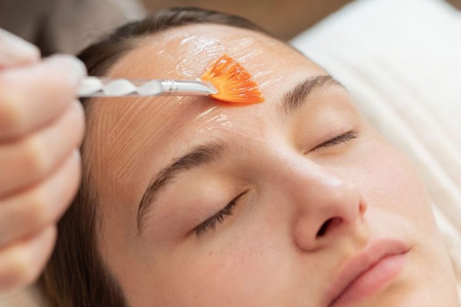 Chemical peel s