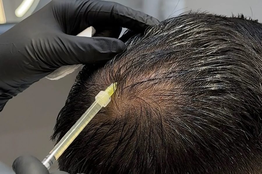 Hair Exosomes therapy