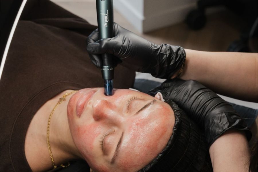 Microneedling