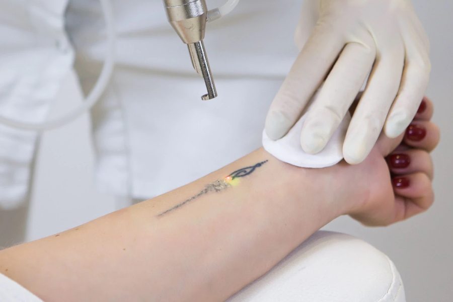 Tatoo Removals